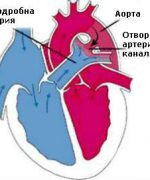 persistira6t-arterialen-canal