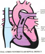 Partial atrioventricular septal defect