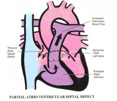 Partial atrioventricular septal defect