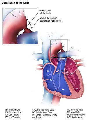 Коарктация на аортата (КоА)