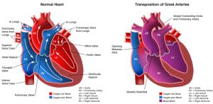 Изолирана транспозиция на големите артерии (ТГА)