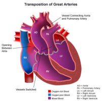 транспозиция на големите артерии