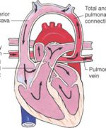 Anomalous infusion of the pulmonary veins