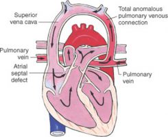Anomalous infusion of the pulmonary veins