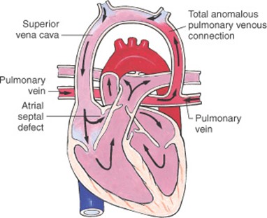 Anomalous infusion of the pulmonary veins